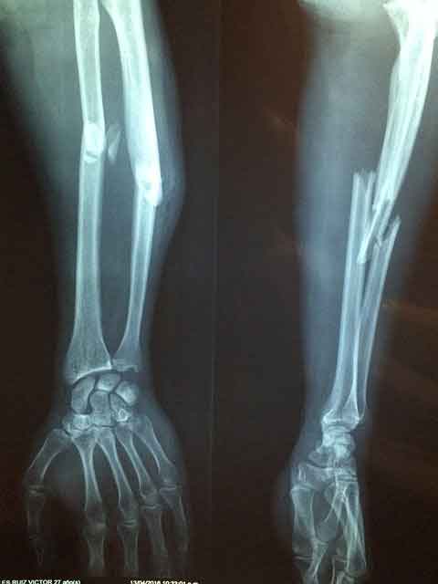 too old to start learning martial arts leads to bone fracture